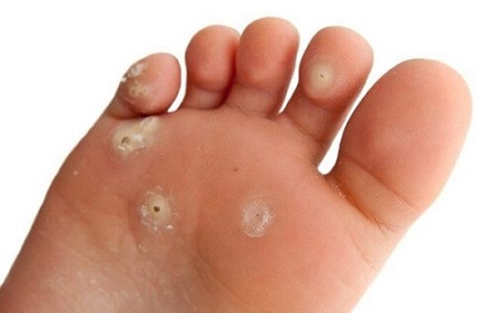 Nguyên nhân gây bệnh sùi mào gà ở bàn chân