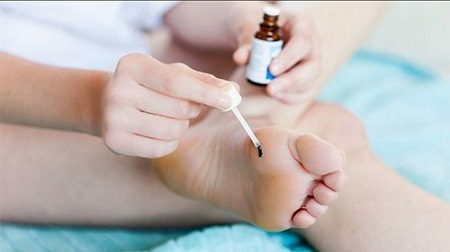 Chữa sùi mào gà ở bàn chân bằng thuốc