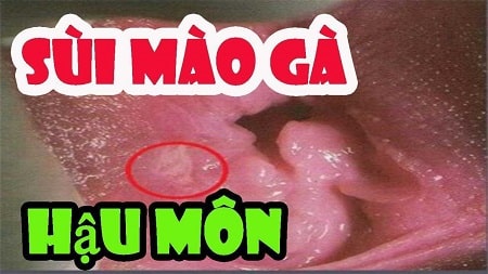 Cách nhận biết biểu hiện sùi mào gà hậu môn nam