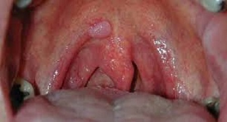 Các nguyên nhân dẫn tới sùi mào gà ở họng