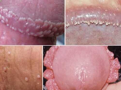 Sùi mào gà ở nam giới triệu chứng nhận biết dễ dàng