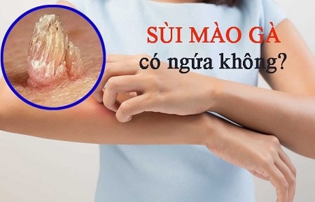 Sùi mào gà ở nữ có ngứa không ?