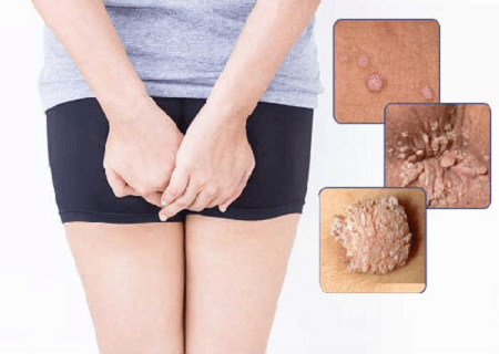 Sùi mào gà trong hậu môn có triệu chứng như thế nào ?