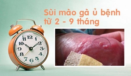 Bệnh sùi mào gà ủ bệnh bao lâu thì phát bệnh?