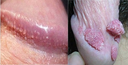 Định nghĩa sùi mào gà và chuỗi hạt ngọc là gì?