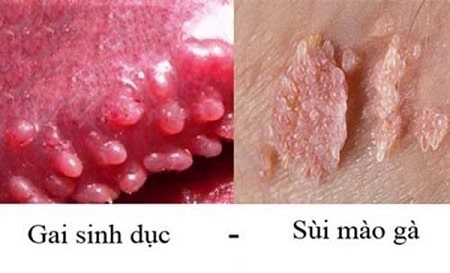 Cách phân biệt sùi mào gà và gai sinh dục 