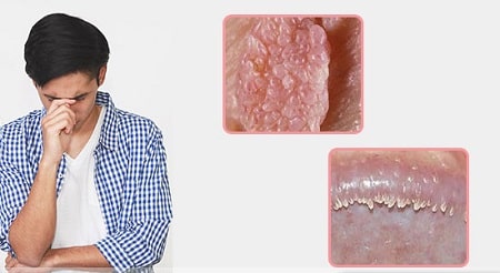 Cách phòng ngừa sùi mào gà và gai sinh dục hiệu quả