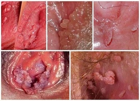Tìm hiểu nguyên nhân bị sùi mào gà ở vùng kín