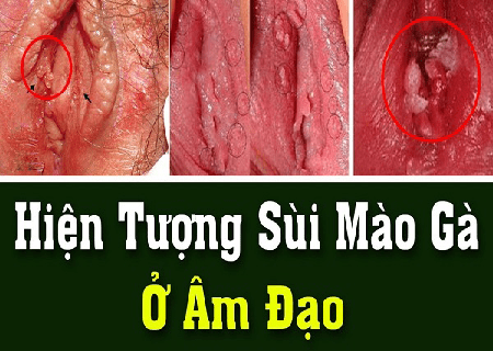 Bị bệnh sùi mào gà ở vùng kín gây ra những biến chứng gì?