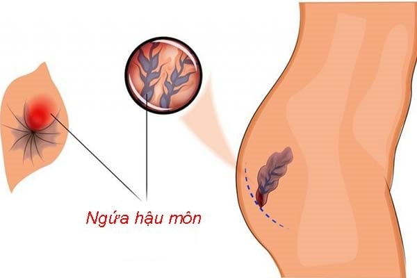 Tại sao bị trĩ lại ngứa hậu môn ?