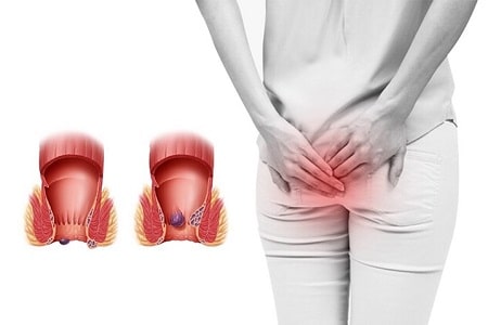 Trĩ là bệnh gì ?
