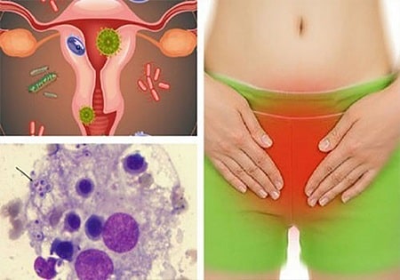 Tìm hiểu thêm: Nấm Candida có tự khỏi không?