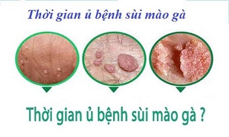 Thời gian ủ bệnh sùi mào gà diễn ra bao lâu mới phát triệu chứng?