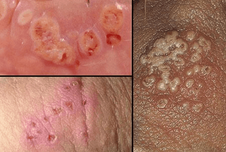 Những nguyên nhân dẫn đến mụn rộp sinh dục nam