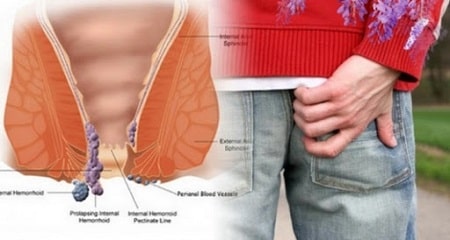 Lúc nào nên dùng thuốc trị bệnh hậu môn?