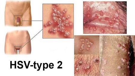 Tổng quan bệnh mụn rộp sinh dục là gì ?