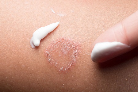 Những loại thuốc trị nấm candida cho nam giới hiệu quả