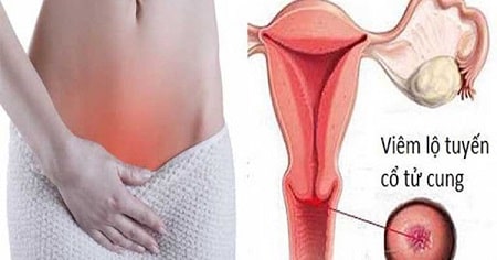 Khi nào nên dùng thuốc trị viêm lộ tuyến cổ tử cung?