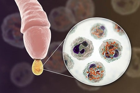 Khi nào cần sử dụng thuốc uống trị viêm bao quy đầu?