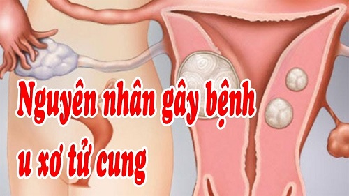 Tổng hợp các nguyên nhân bệnh u xơ cổ tử cung nữ giới cần biết