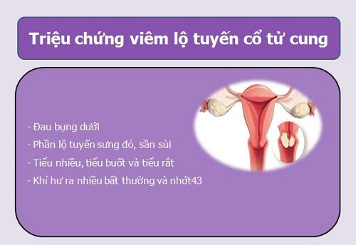 Triệu chứng viêm lộ tuyến cổ tử cung