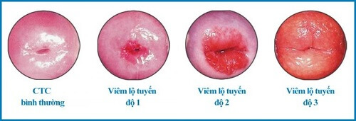 Tìm hiểu về các cấp độ bệnh viêm lộ tuyến tử cung