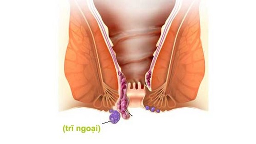 Bệnh trĩ ngoại