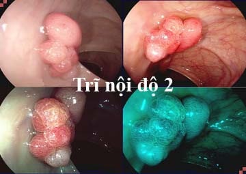 Cách chữa trĩ nội độ 2 như thế nào?