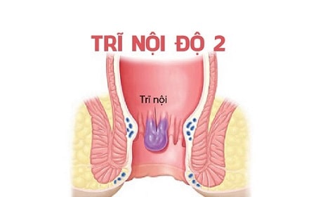 Trĩ nội độ 2 là gì ?