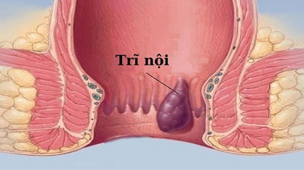 Trĩ nội là gì ?