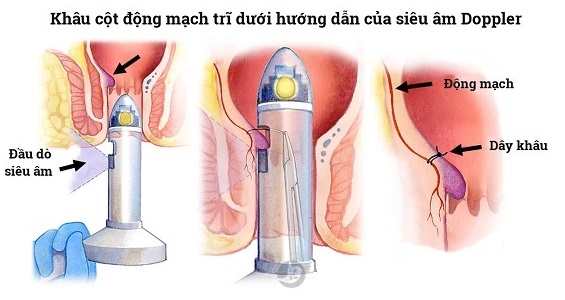 Triệt mạch bằng siêu âm Doppler – THD