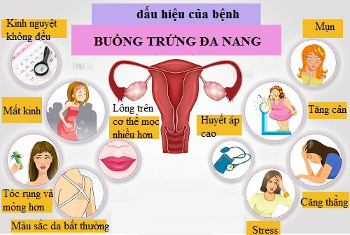 Triệu chứng buồng chứng đa nang
