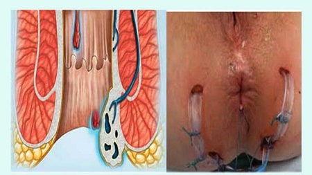 Triệu chứng rò hậu môn có gây nguy hiểm gì không?