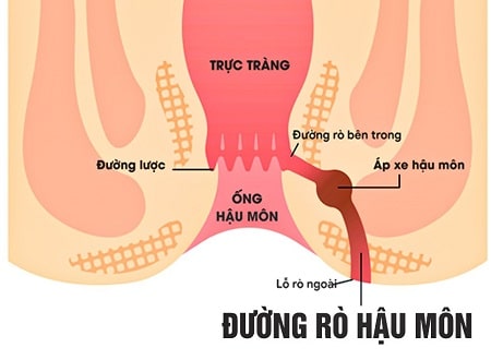 Rò hậu môn là gì?