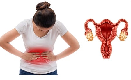 Cảnh báo u nang buồng trứng gây rối loạn kinh nguyệt ở nữ giới 