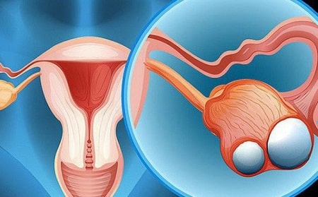 U nang buồng trứng là gì? 