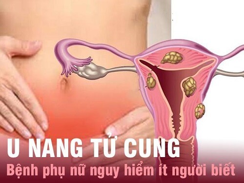 Bệnh u nang tử cung