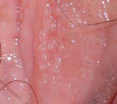 U nhú sinh dục ở nữ giới