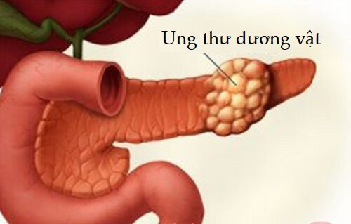 Nổi hột đỏ ngứa ở vùng kín do ung thư dương vật