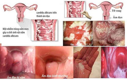 Viêm âm đạo 