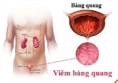  Đái rắt- Biểu hiện bệnh viêm bàng quang 