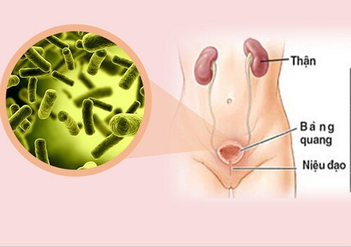 Đái buốt đái rắt ở phụ nữ - Cảnh báo viêm bàng quang