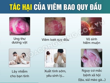 Viêm bao quy đầu có nguy hiểm không, gây biến chứng gì?