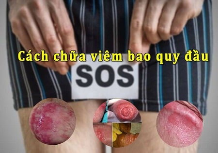 Vì sao cần điều trị viêm bao quy đầu càng sớm càng tốt?