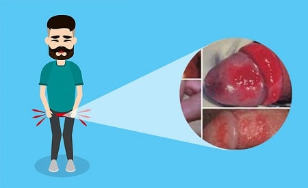 Triệu chứng của người bị viêm bao quy đầu mãn tính