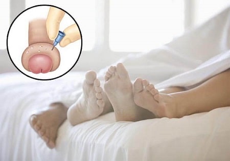Tìm hiểu về bệnh viêm bao quy đầu sau quan hệ