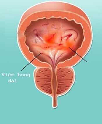 Viêm bọng đái