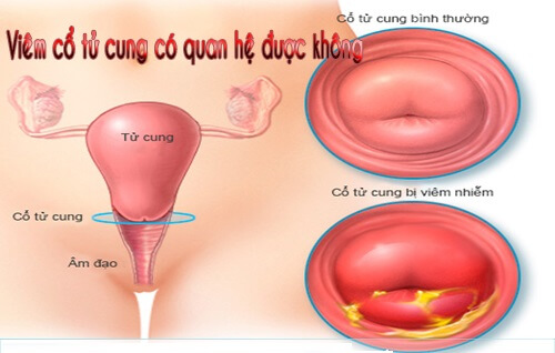 Viêm cổ tử cung nhẹ có quan hệ được không?