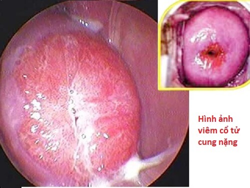 Viêm cổ tử cung nặng