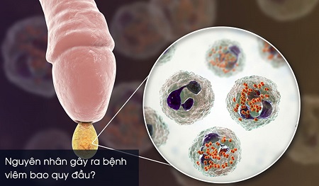 Nguyên nhân gây ra viêm da quy đầu do đâu?